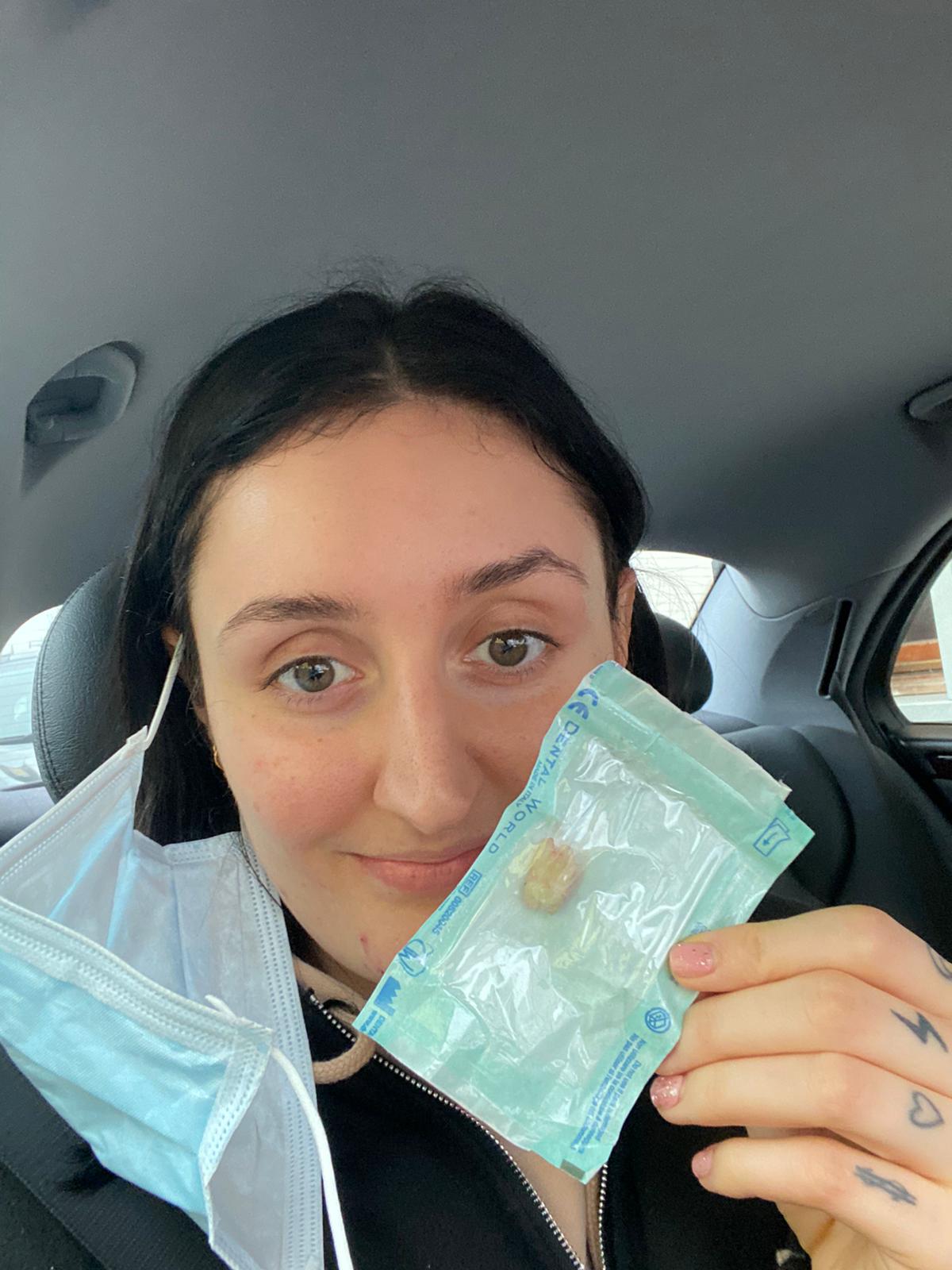 Strappare i denti del giudizio fa male